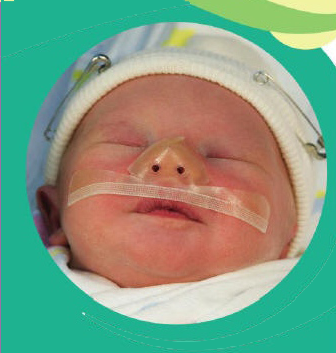 Cannulaide baby